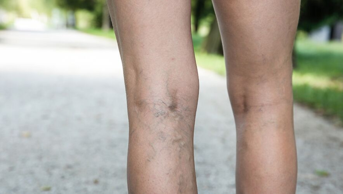 người bị giãn tĩnh mạch có nên chạy bộ không?